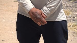 يد عمر الجميلي التي تعوقت جراء اللغم